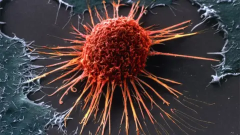 Science Photo Library A coloured scanning electron micrograph (SEM) of a cervical cancer cell.