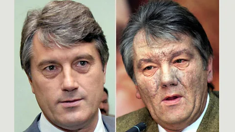 Getty Images Victor Yushchenko's face was damaged with poison, possibly to affect his electability (Credit: Getty Images)